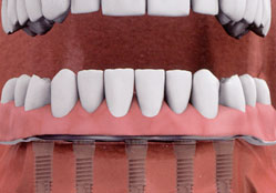 dantu implantai